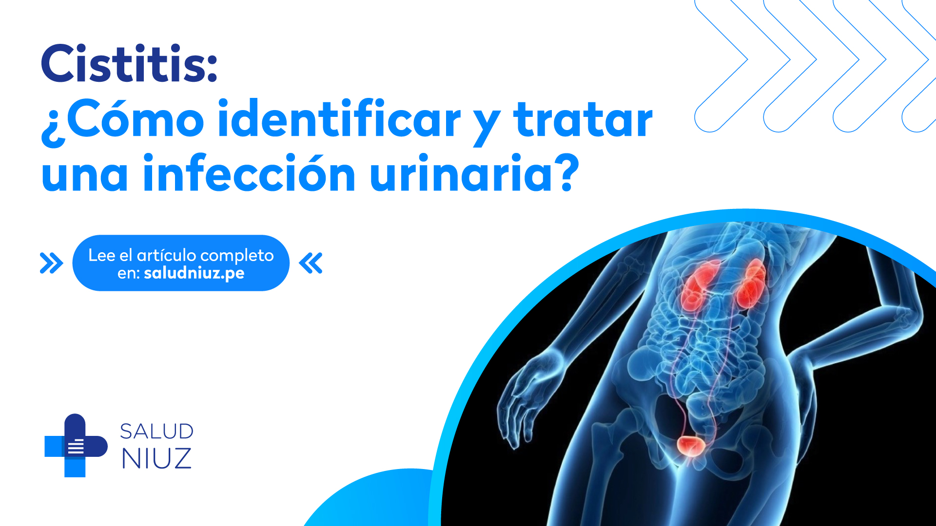 Cistitis Cómo identificar y tratar una infección urinaria SaludNiuz pe